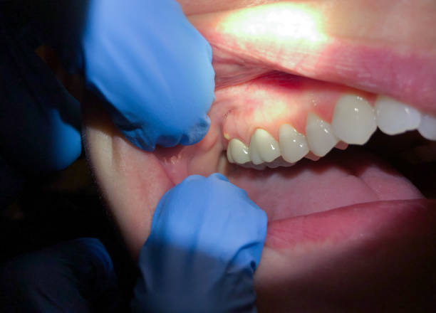 Best Emergency Treatment for Oral Infections in Peosta, IA